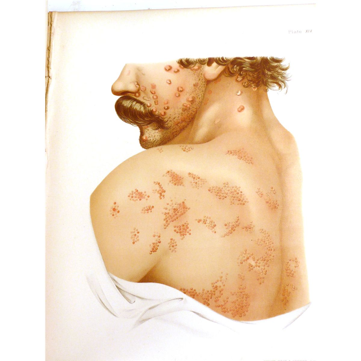 Atlas of Skin and Venereal Diseases William and Wood Atlas of Skin and Venereal Diseases William and Wood
